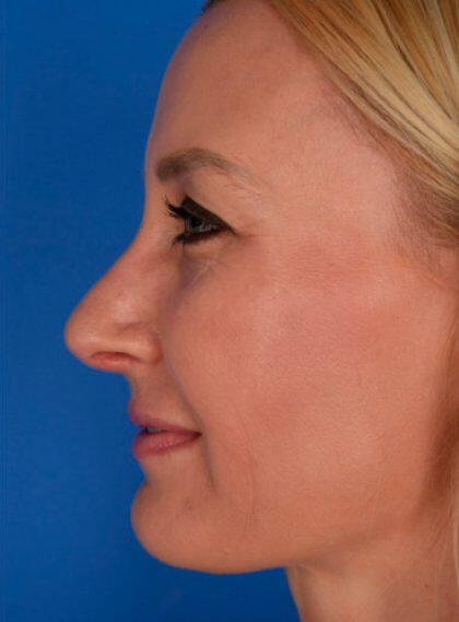 Rhinoplasty Before & After Image