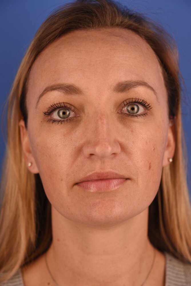 Rhinoplasty Before & After Image