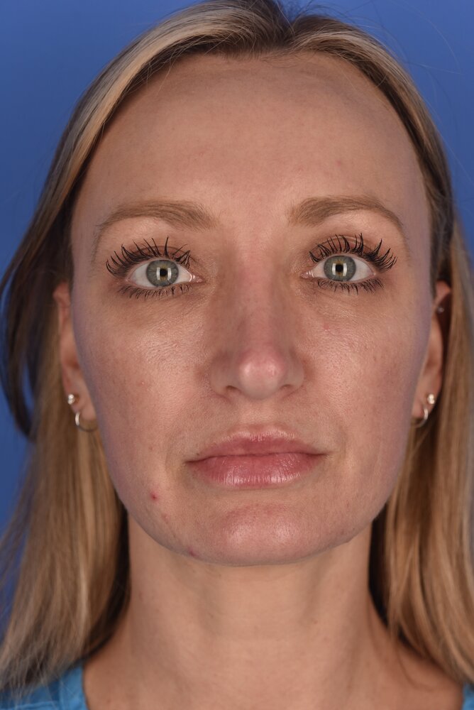 Rhinoplasty Before & After Image