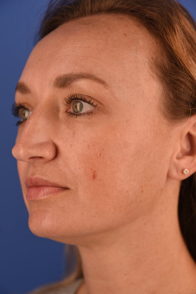 Rhinoplasty Before & After Image