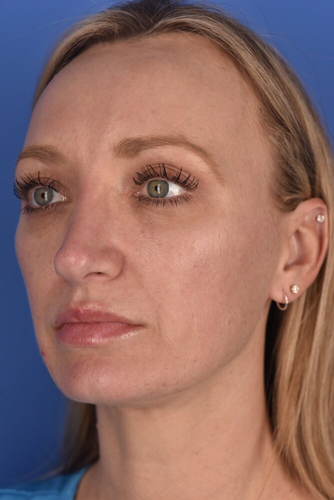 Rhinoplasty Before & After Image