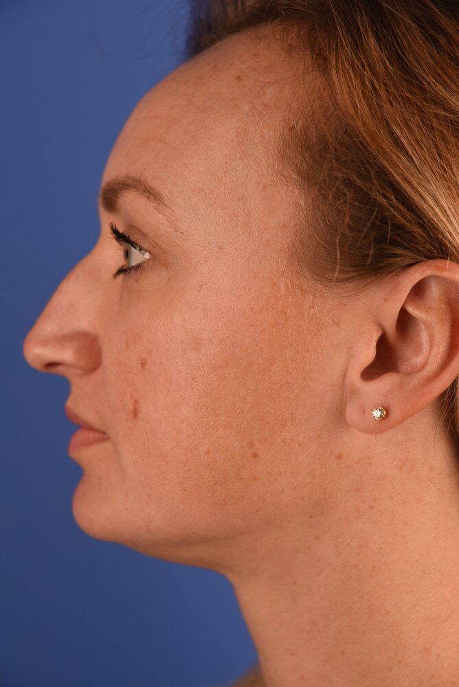 Rhinoplasty Before & After Image