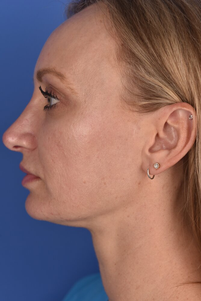 Rhinoplasty Before & After Image