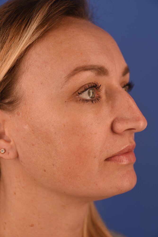 Rhinoplasty Before & After Image