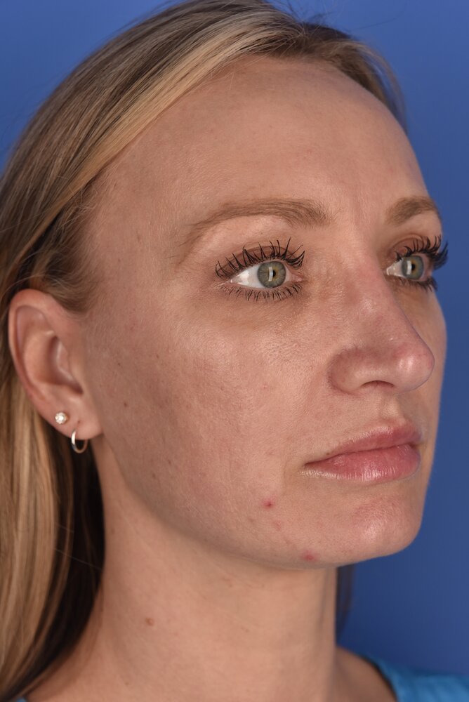 Rhinoplasty Before & After Image