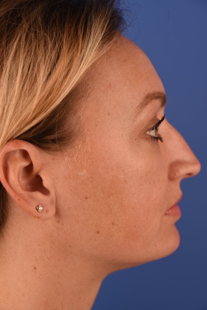 Rhinoplasty Before & After Image