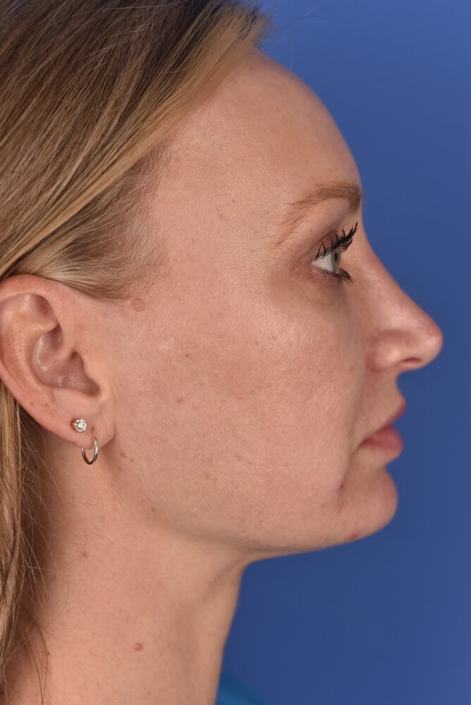 Rhinoplasty Before & After Image