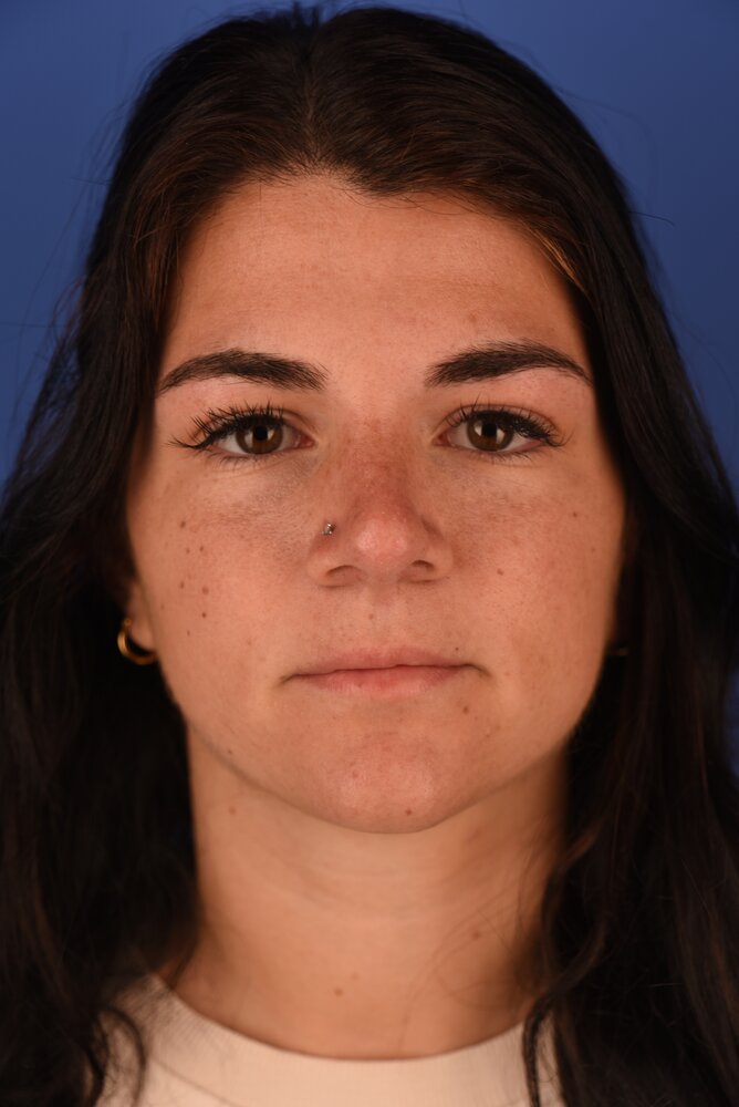 Rhinoplasty Before & After Image