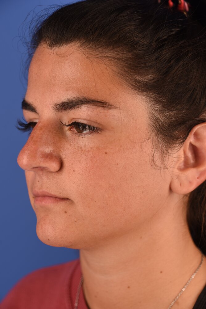 Rhinoplasty Before & After Image