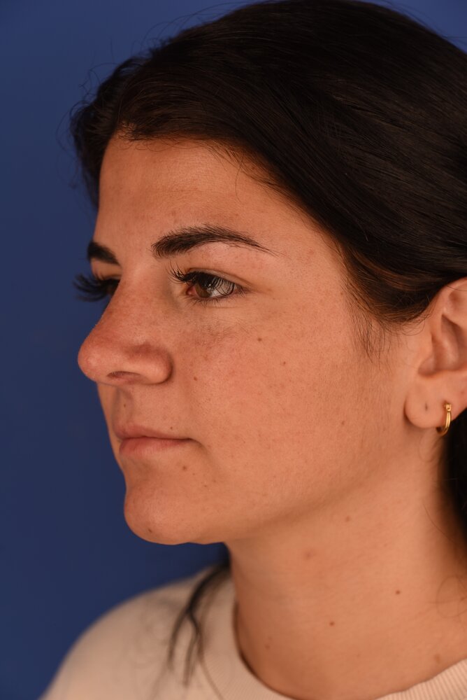Rhinoplasty Before & After Image