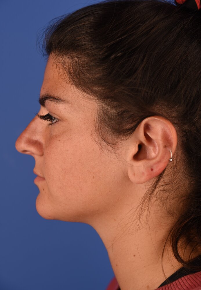 Rhinoplasty Before & After Image