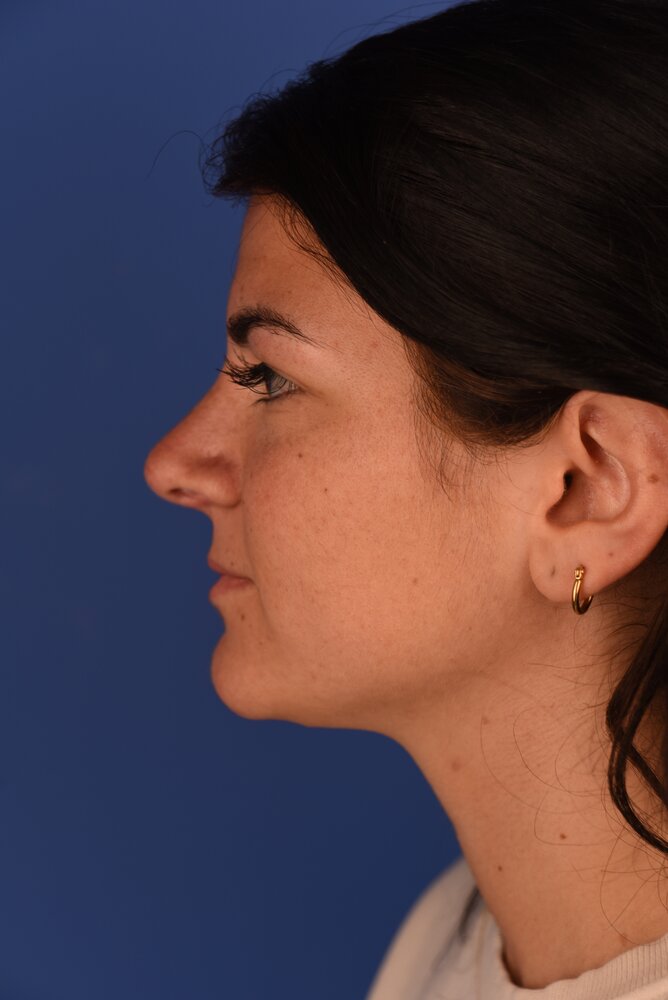 Rhinoplasty Before & After Image