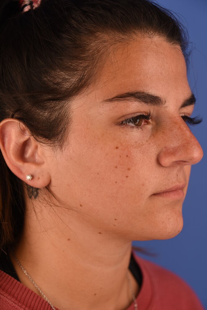 Rhinoplasty Before & After Image