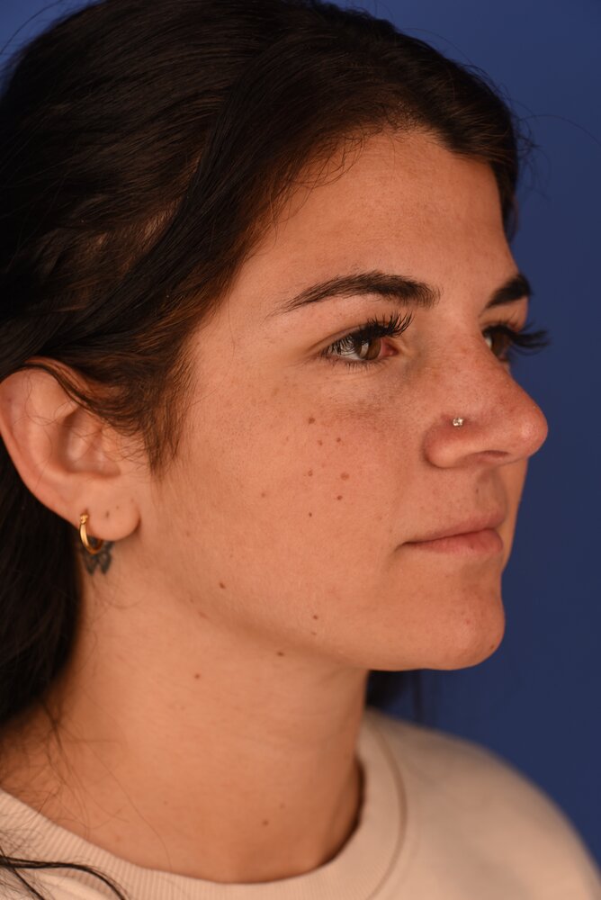 Rhinoplasty Before & After Image