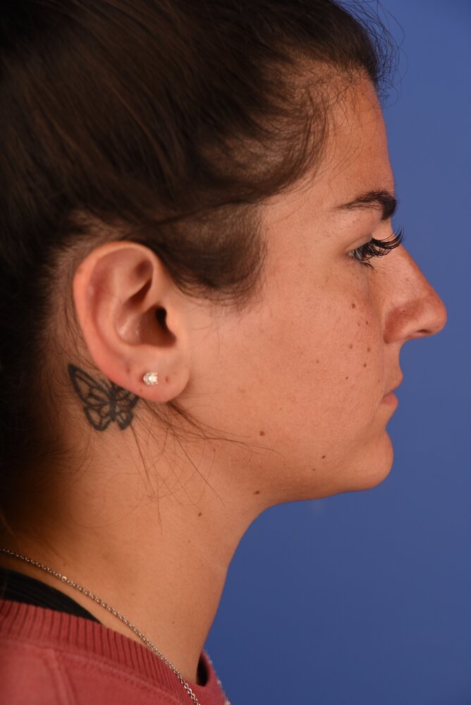 Rhinoplasty Before & After Image