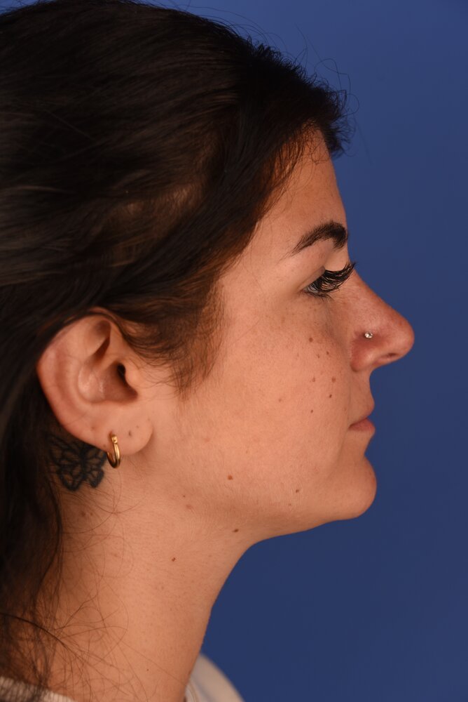 Rhinoplasty Before & After Image