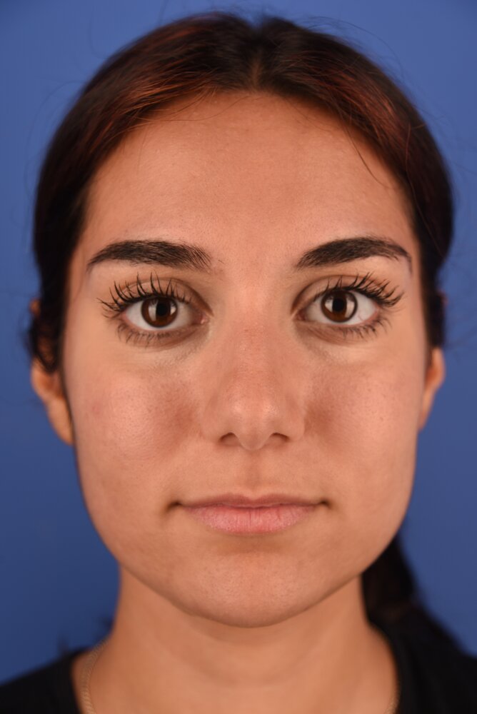 Rhinoplasty Before & After Image