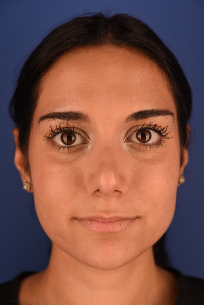 Rhinoplasty Before & After Image