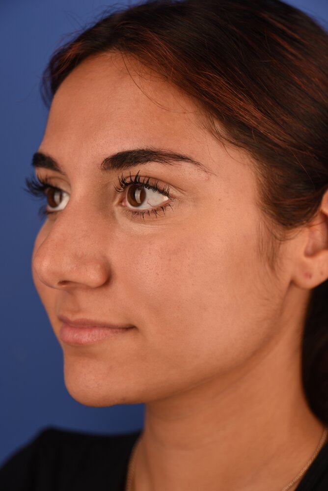 Rhinoplasty Before & After Image