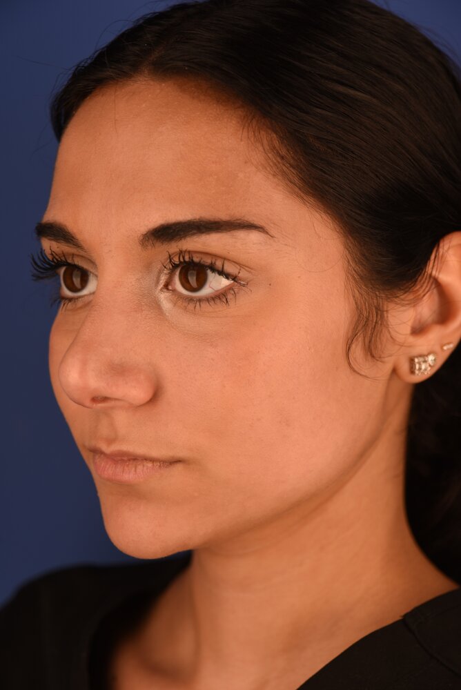 Rhinoplasty Before & After Image