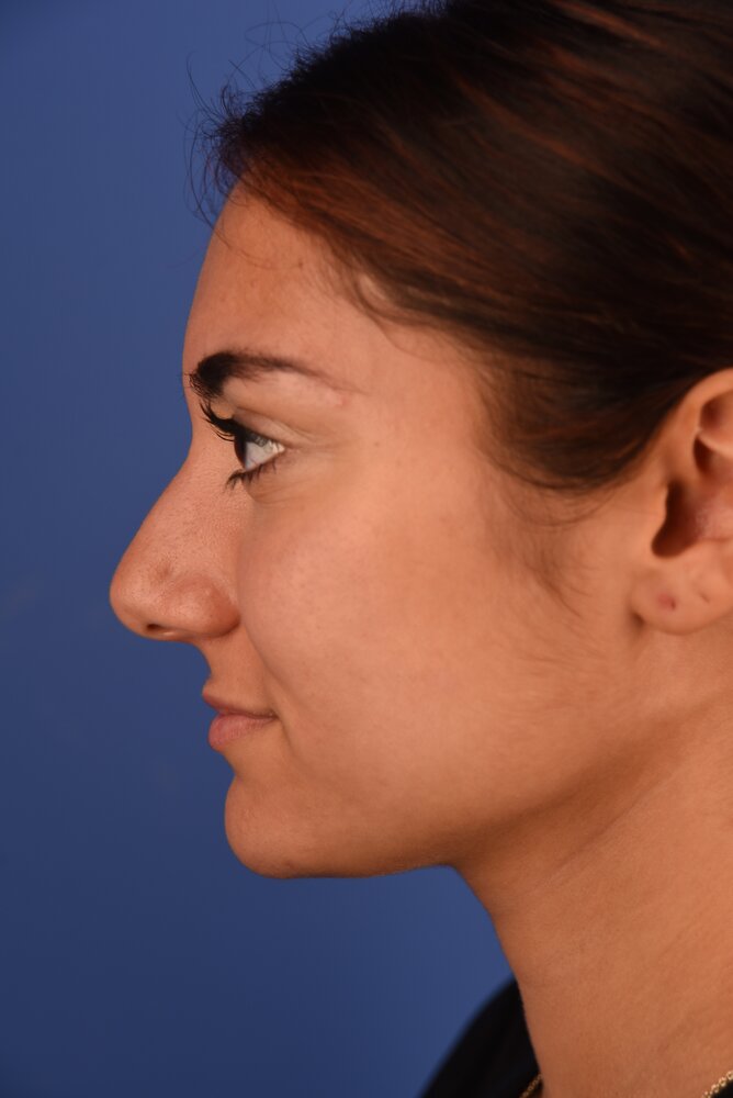 Rhinoplasty Before & After Image