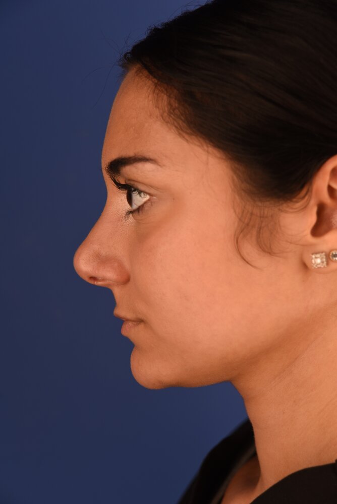 Rhinoplasty Before & After Image