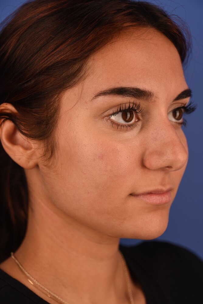 Rhinoplasty Before & After Image