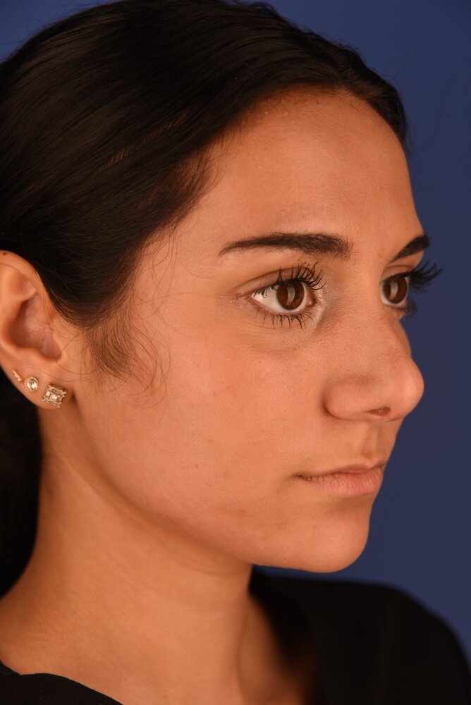 Rhinoplasty Before & After Image