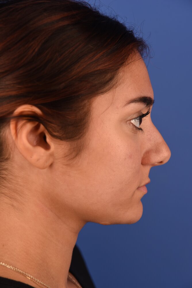 Rhinoplasty Before & After Image