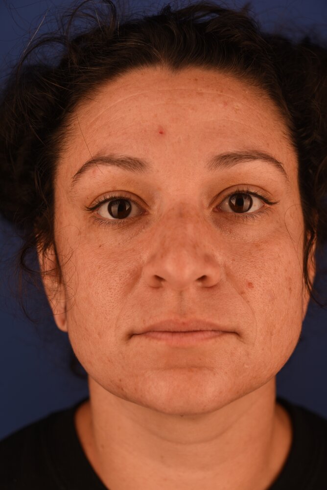 Rhinoplasty Before & After Image