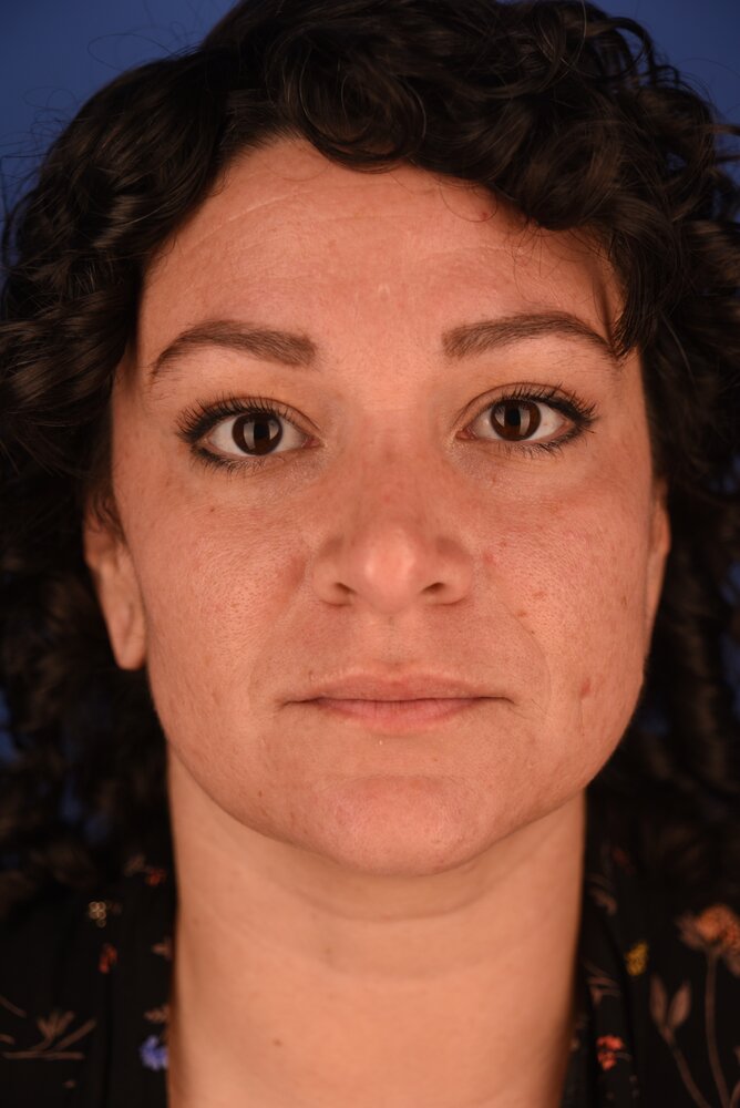 Rhinoplasty Before & After Image