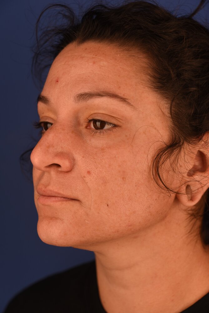 Rhinoplasty Before & After Image