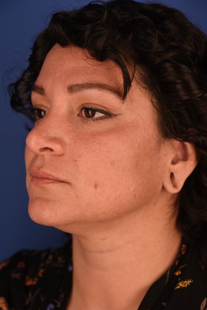 Rhinoplasty Before & After Image
