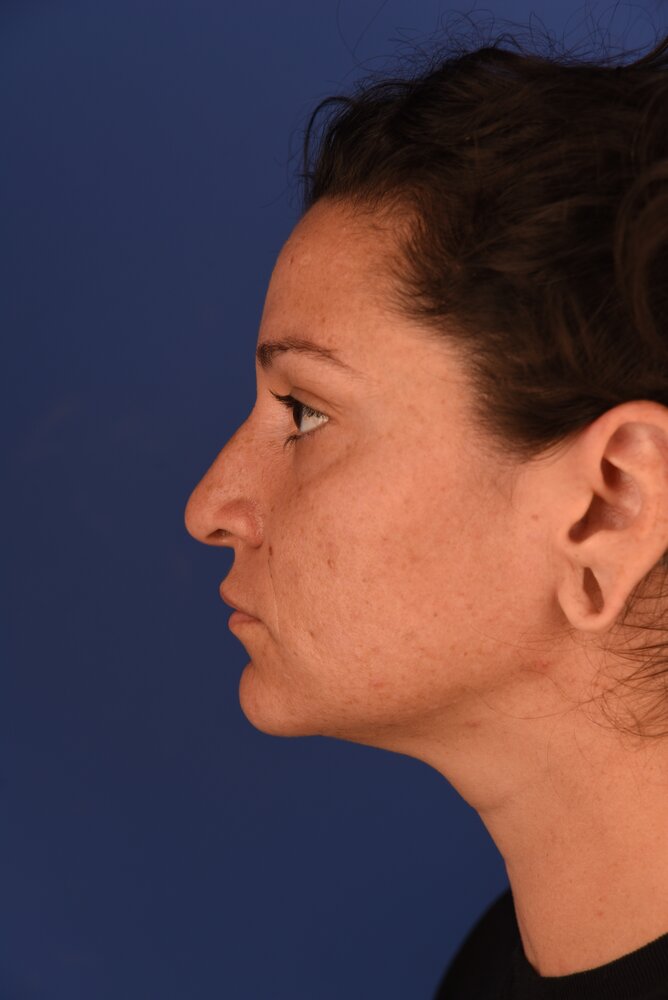 Rhinoplasty Before & After Image
