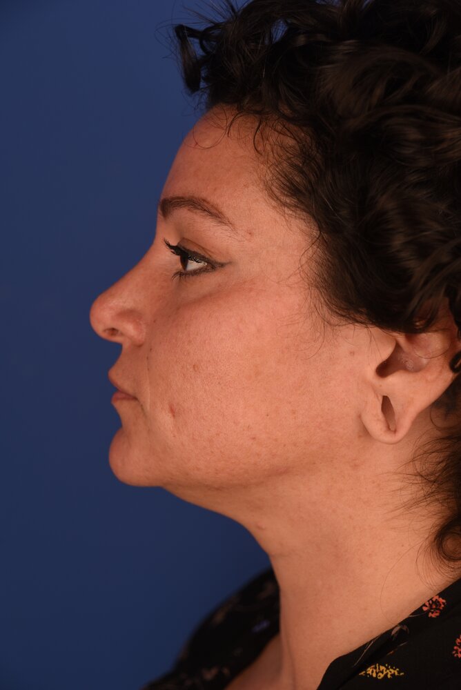 Rhinoplasty Before & After Image
