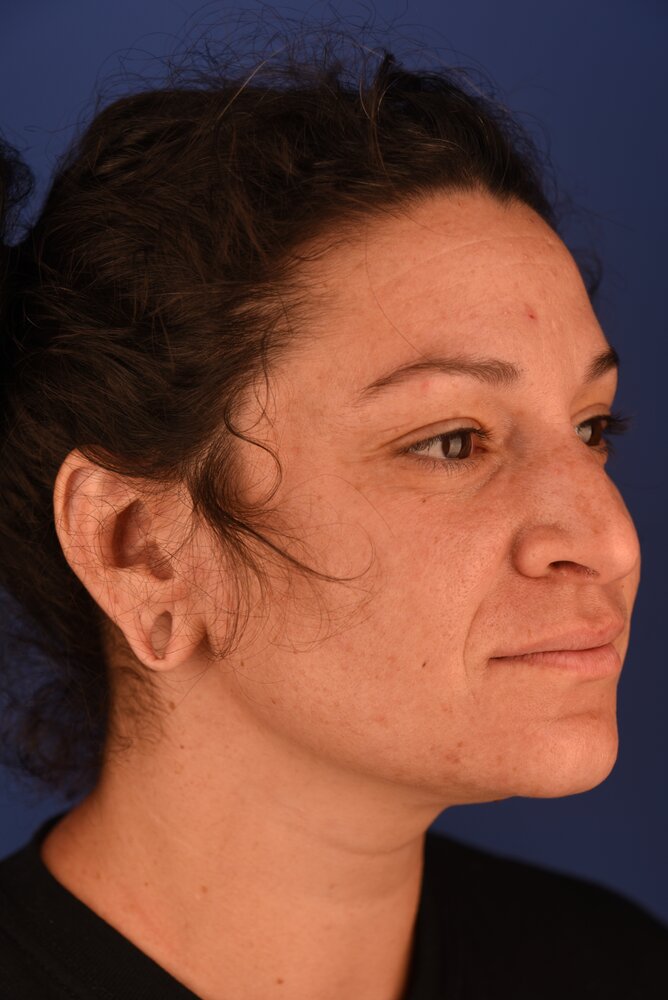 Rhinoplasty Before & After Image