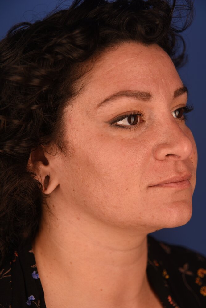 Rhinoplasty Before & After Image
