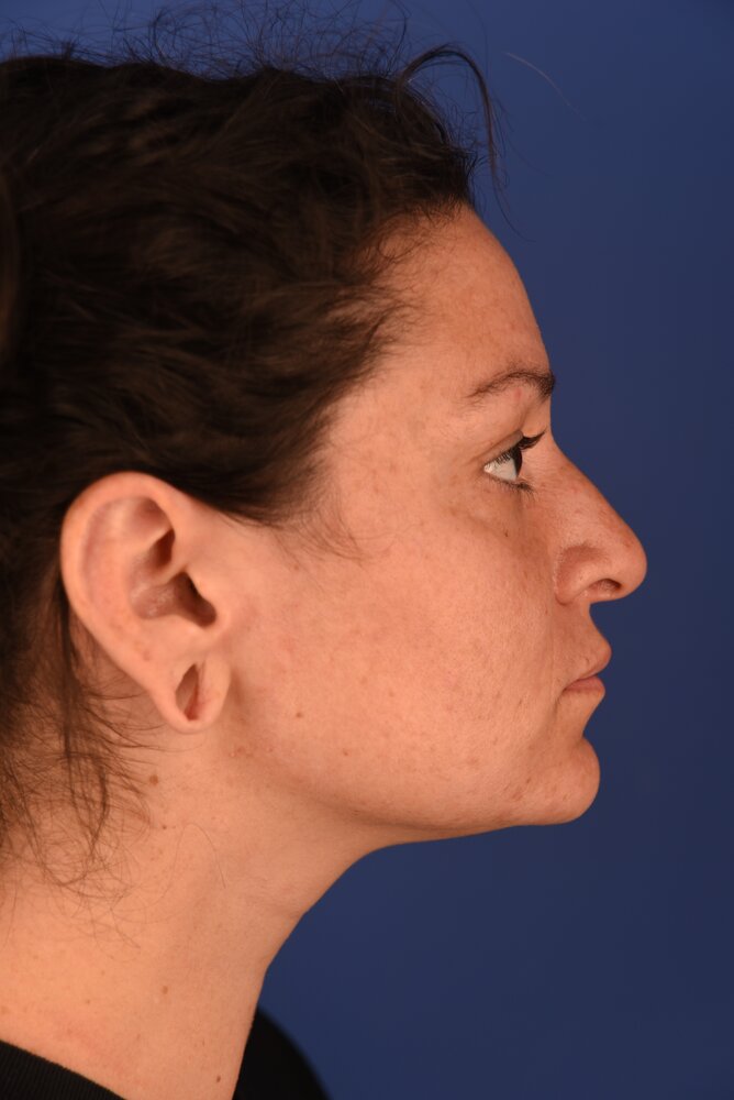 Rhinoplasty Before & After Image