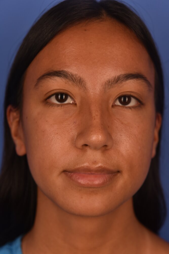 Rhinoplasty Before & After Image