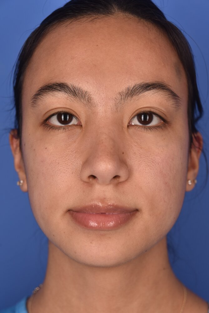 Rhinoplasty Before & After Image