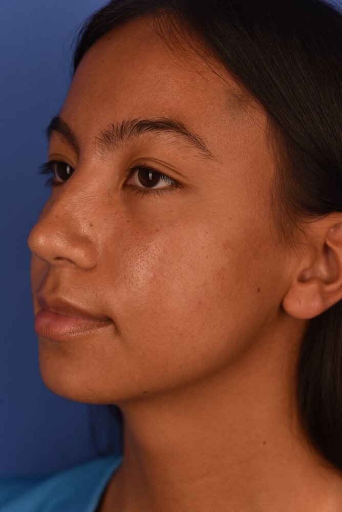 Rhinoplasty Before & After Image