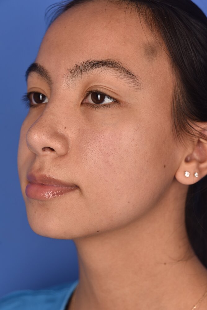 Rhinoplasty Before & After Image