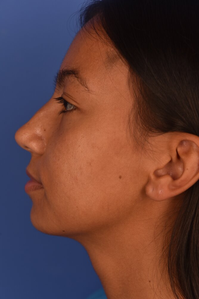 Rhinoplasty Before & After Image