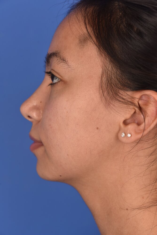 Rhinoplasty Before & After Image