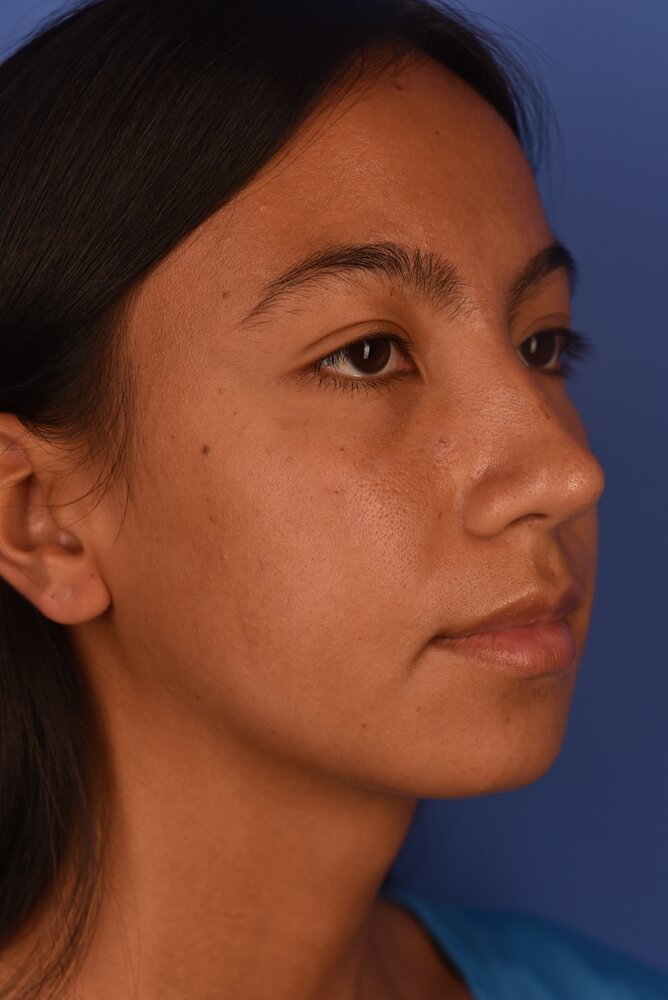 Rhinoplasty Before & After Image