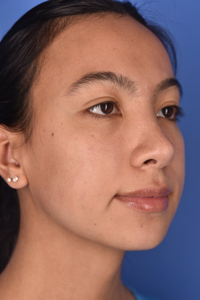 Rhinoplasty Before & After Image