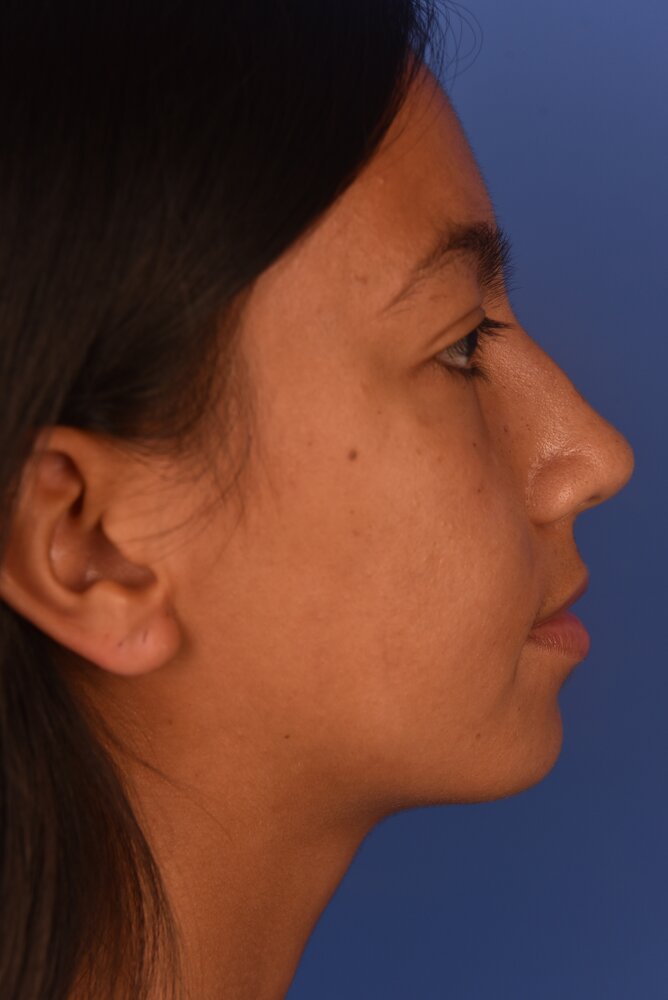 Rhinoplasty Before & After Image