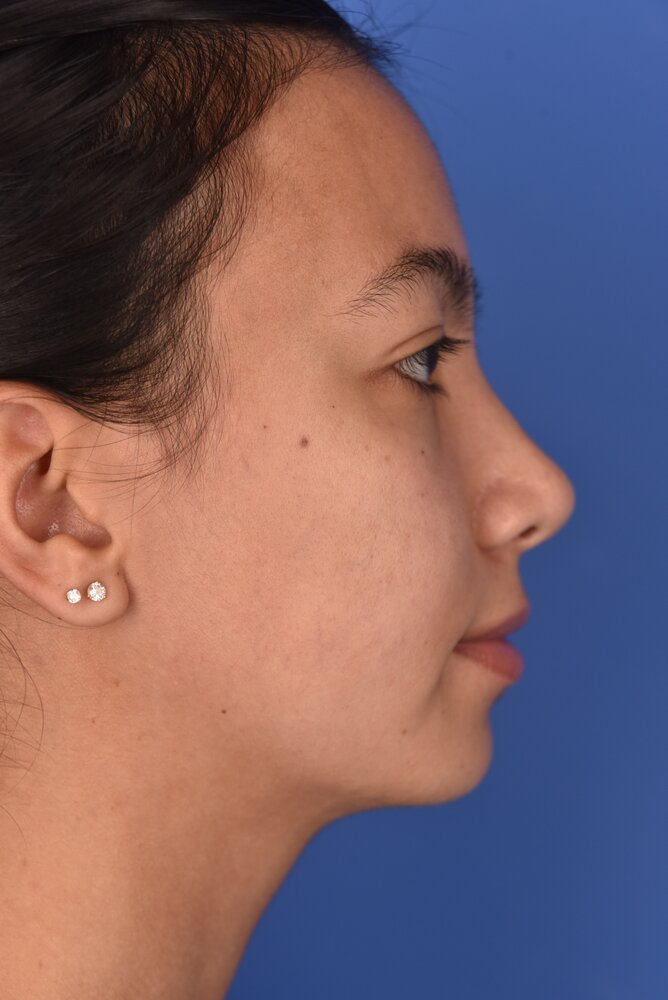 Rhinoplasty Before & After Image
