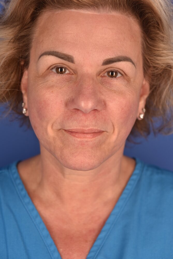 Rhinoplasty Before & After Image