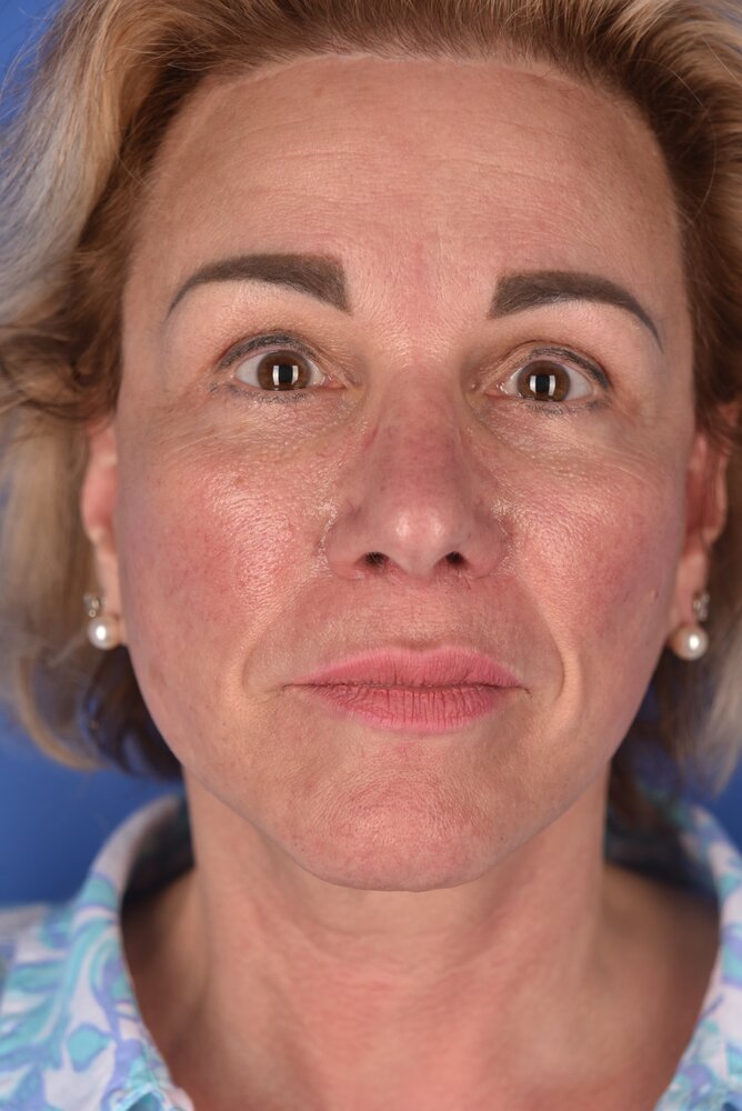 Rhinoplasty Before & After Image